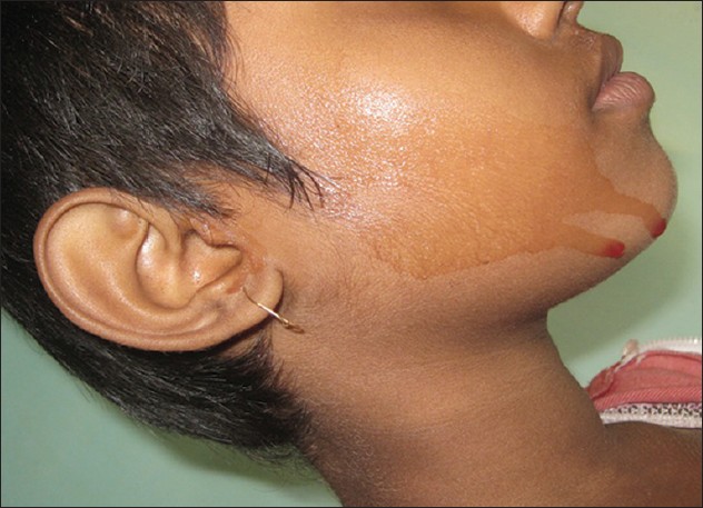 hematohidrosis